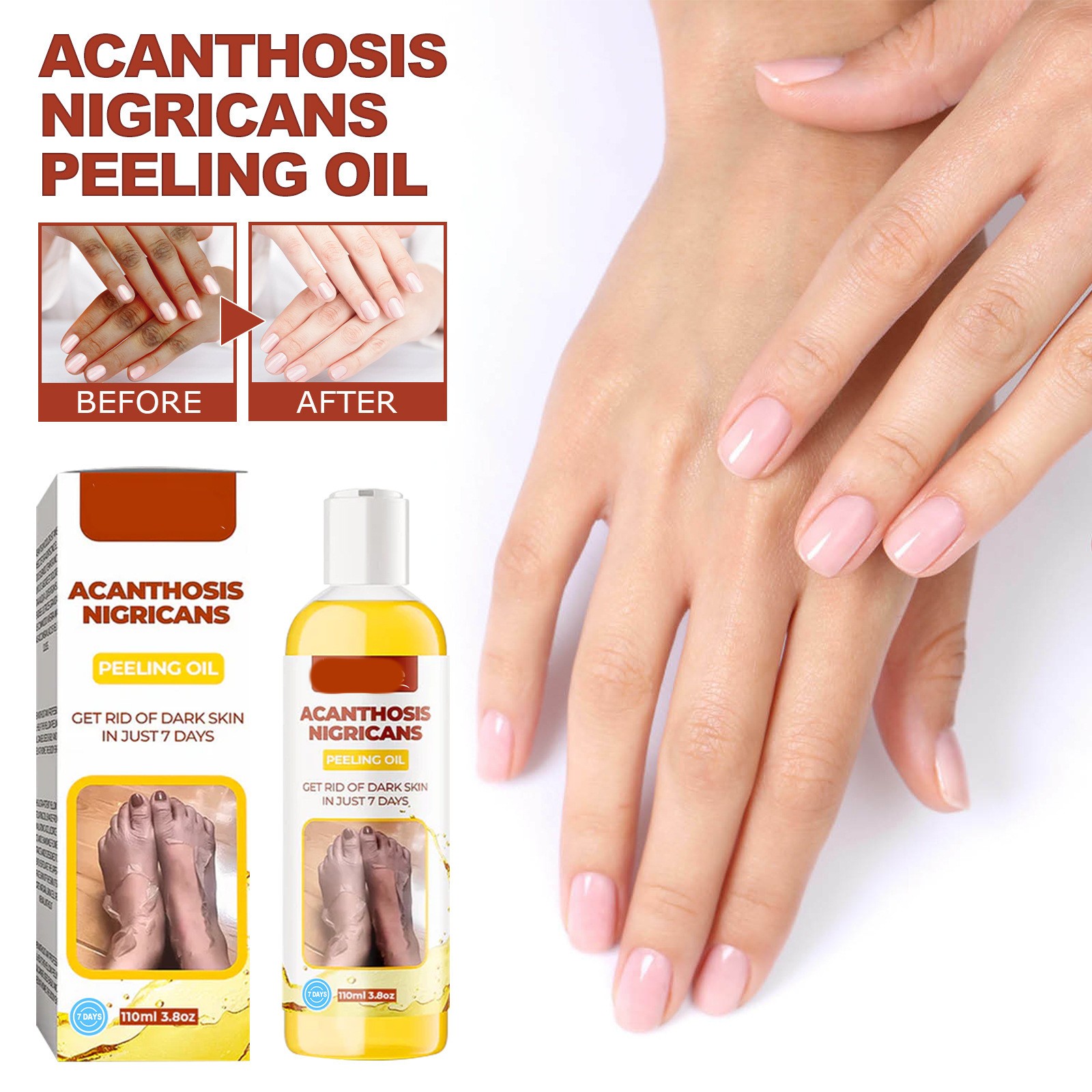 Acanthosis Nigricans Peeling Oil  Remove Dark Skin in Just 7 Days