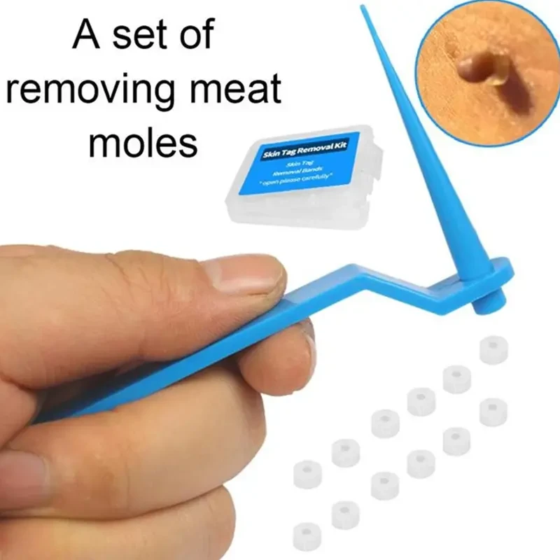 Set Skin Tag Kill Skin Mole Wart Remover