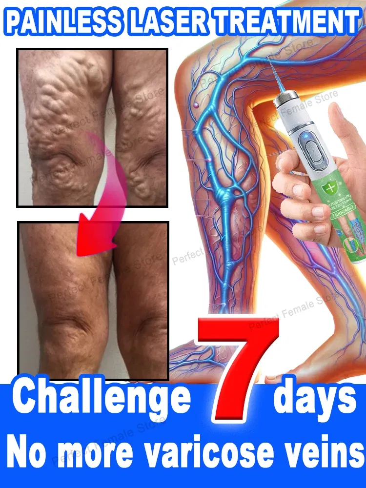 Color: Blue - Varicose Veins Products