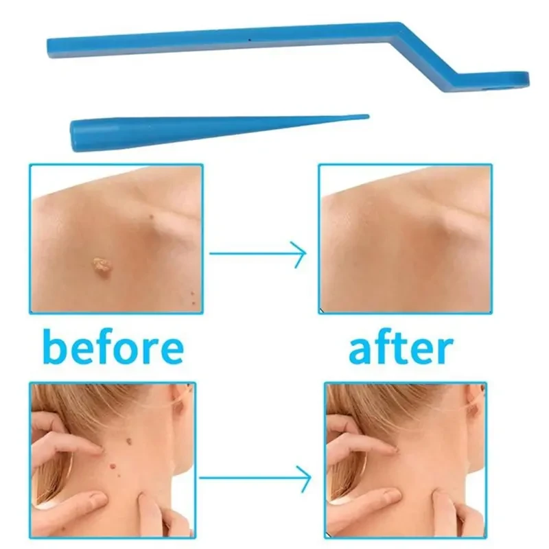 Set Skin Tag Kill Skin Mole Wart Remover