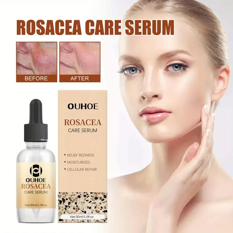 OUHOE Rosacea Care Serum, 60pcs, Facial Skincare, Essential Oils, Moisturizes & Nourishes, Reduces Skin Redness, Soothes & Eliminates Scaly Skin, Suitable for All Skin Types, with Glycerin, Tea Tree, Aloe Vera, and Urea