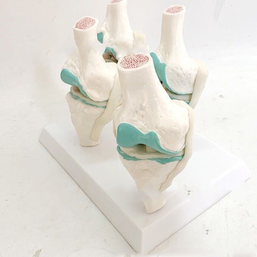 Four-Stage Diseased Knee Joint Model Sick Joint Model