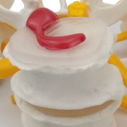 4-Stage Diseased Lumbar Spine Model Medical Teaching Equipment