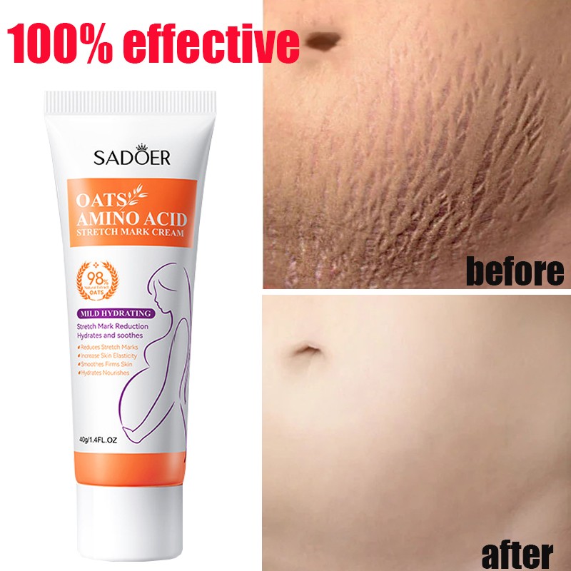 Stretch Marks Permanent Removal Cream - Skin Repair and Firming Care