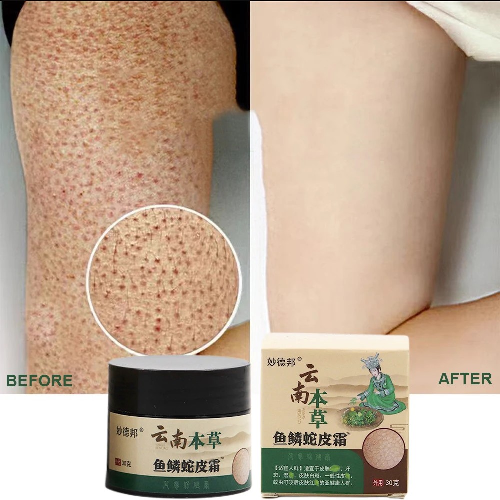 Chicken Skin Repair Cream - Keratosis Pilaris Treatment and Pore Smoothing
