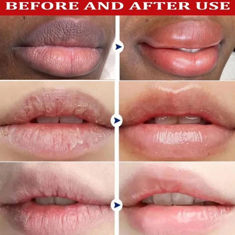 Remove Dark Lip Balm - Lightening & Moisturizing Korean Lip Care