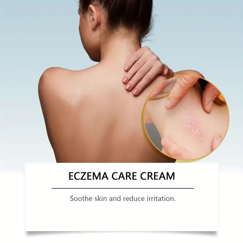 Bee Venom Eczema Care Cream - Soothing & Moisturizing Relief for All Skin Types