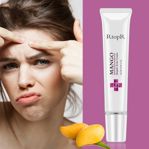 RtopR mango acne cream