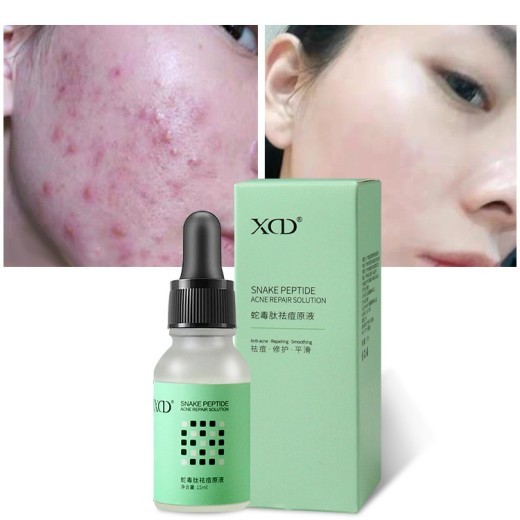 Facial Acne Repair Shrink Pores Moisturizing