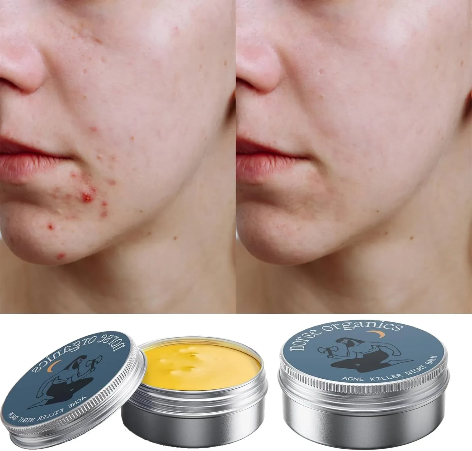 Acne Treatment Cream, Muscle Joint Skin Moisturizing Cream