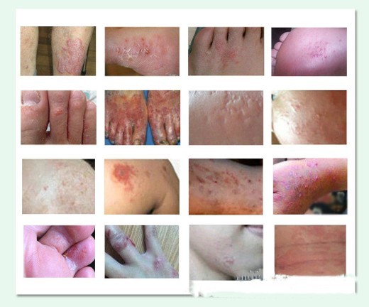 Itchy Skin Care Skin care lotion